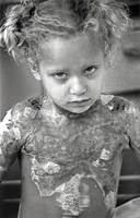 4-year old Heather Eaton was burned while playing with matches.