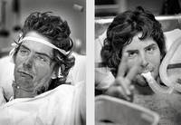 J.C. Gift: 10 days after being burned (left) and after 21 days and several graftings.